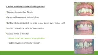 2. Lower inclined plane or Catalan’s appliance
Crossbite involving 1 or 2 teeth
Cemented lower acrylic inclined plane
Contoured and polished at 450 angle to long axis of lower incisor teeth
Steeper the angle , greater the force applied
Weekly review to monitor:
◦ More than 2 or 3 weeks: may open bite
◦ Labial movement of maxillary incisors
 
