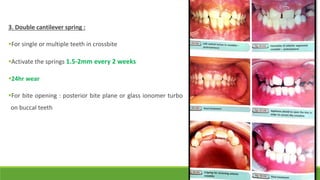 3. Double cantilever spring :
For single or multiple teeth in crossbite
Activate the springs 1.5-2mm every 2 weeks
24hr wear
For bite opening : posterior bite plane or glass ionomer turbo
on buccal teeth
 