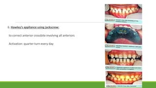 6. Hawley’s appliance using jackscrew:
to correct anterior crossbite involving all anteriors
Activation: quarter turn every day
 