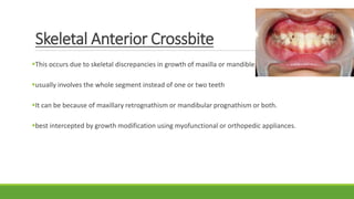 Skeletal Anterior Crossbite
This occurs due to skeletal discrepancies in growth of maxilla or mandible.
usually involves the whole segment instead of one or two teeth
It can be because of maxillary retrognathism or mandibular prognathism or both.
best intercepted by growth modification using myofunctional or orthopedic appliances.
 
