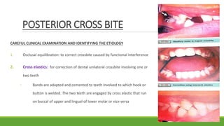 POSTERIOR CROSS BITE
CAREFUL CLINICAL EXAMINATION AND IDENTIFYING THE ETIOLOGY
1. Occlusal equilibration: to correct crossbite caused by functional interference
2. Cross elastics: for correction of dental unilateral crossbite involving one or
two teeth
◦ Bands are adapted and cemented to teeth involved to which hook or
button is welded. The two teeth are engaged by cross elastic that run
on buccal of upper and lingual of lower molar or vice versa
 