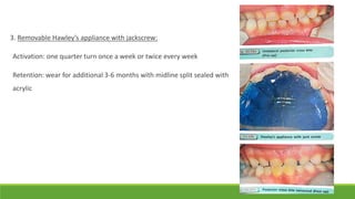 3. Removable Hawley’s appliance with jackscrew:
Activation: one quarter turn once a week or twice every week
Retention: wear for additional 3-6 months with midline split sealed with
acrylic
 