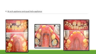 4. W arch appliance and quad helix appliance
 