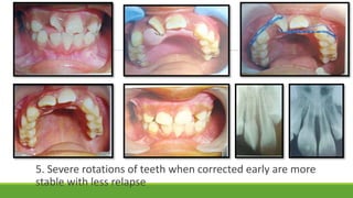 5. Severe rotations of teeth when corrected early are more
stable with less relapse
 