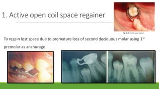 1. Active open coil space regainer
To regain lost space due to premature loss of second deciduous molar using 1st
premolar as anchorage
 