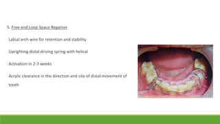 5. Free end Loop Space Regainer
Labial arch wire for retention and stability
Uprighting distal driving spring with helical
Activation in 2-3 weeks
Acrylic clearance in the direction and site of distal movement of
tooth
 