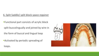 6. Split Saddle/ split block space regainer
Functional part consists of acrylic block
split buccolingually and joined by wire in
the form of buccal and lingual loop
Activated by periodic spreading of
loops.
 