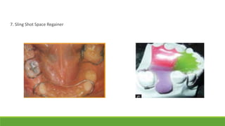 7. Sling Shot Space Regainer
 