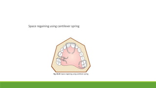 Space regaining using cantilever spring
 