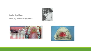 Kloehn Head Gear
Jones Jig/ Pendulum appliance
 