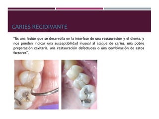 CARIES RECIDIVANTE
“Es una lesión que se desarrolla en la interfase de una restauración y el diente, y
nos pueden indicar una susceptibilidad inusual al ataque de caries, una pobre
preparación cavitaria, una restauración defectuosa o una combinación de estos
factores”.
Figueroa-Gordon M.
 