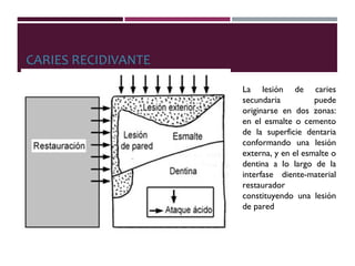CARIES RECIDIVANTE
La lesión de caries
secundaria puede
originarse en dos zonas:
en el esmalte o cemento
de la superficie dentaria
conformando una lesión
externa, y en el esmalte o
dentina a lo largo de la
interfase diente-material
restaurador
constituyendo una lesión
de pared
 
