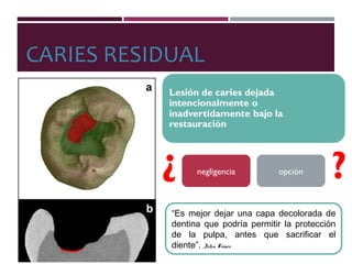 CARIES RESIDUAL
negligencia opción¿ ¿
“Es mejor dejar una capa decolorada de
dentina que podría permitir la protección
de la pulpa, antes que sacrificar el
diente”. John Tomes
 