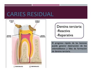 CARIES RESIDUAL
Dentina terciaria:
-Reactiva
-Reparativa
El progreso rápido de las lesiones
puede generar destrucción de los
odontoblastos y falta de formación
de dentina terciaria.
 