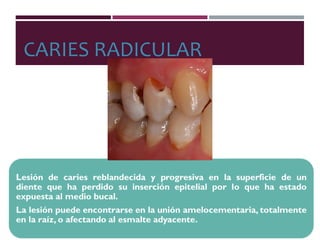 CARIES RADICULAR
 
