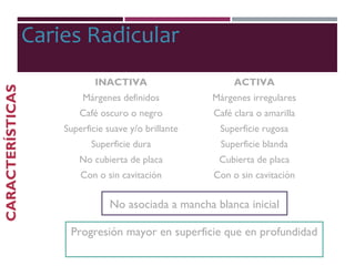 No asociada a mancha blanca inicial
Caries Radicular
CARACTERÍSTICAS
INACTIVA ACTIVA
Márgenes definidos Márgenes irregulares
Café oscuro o negro Café clara o amarilla
Superficie suave y/o brillante Superficie rugosa
Superficie dura Superficie blanda
No cubierta de placa Cubierta de placa
Con o sin cavitación Con o sin cavitación
Progresión mayor en superficie que en profundidad
 