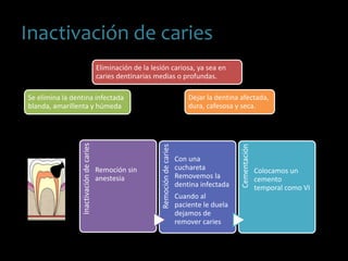 Inactivación de caries
Eliminación de la lesión cariosa, ya sea en
caries dentinarias medias o profundas.
Se elimina la dentina infectada
blanda, amarillenta y húmeda
Dejar la dentina afectada,
dura, cafesosa y seca.
Inactivacióndecaries
Remoción sin
anestesia
Remocióndecaries
Con una
cuchareta
Removemos la
dentina infectada
Cuando al
paciente le duela
dejamos de
remover caries
Cementación
Colocamos un
cemento
temporal como VI
 