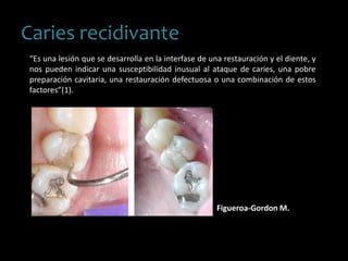 Caries recidivante
“Es una lesión que se desarrolla en la interfase de una restauración y el diente, y
nos pueden indicar una susceptibilidad inusual al ataque de caries, una pobre
preparación cavitaria, una restauración defectuosa o una combinación de estos
factores”(1).
Figueroa-Gordon M.
 