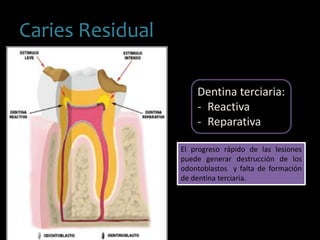 Caries Residual
Dentina terciaria:
- Reactiva
- Reparativa
El progreso rápido de las lesiones
puede generar destrucción de los
odontoblastos y falta de formación
de dentina terciaria.
 