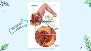 Braquiterapia
Interna
 