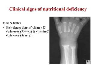Clinical signs of nutritional deficiency
Joins & bones
• Help detect signs of vitamin D
deficiency (Rickets) & vitamin C
deficiency (Scurvy)
 