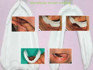 Mandibular border molding
 