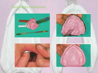 Secondary impression
 