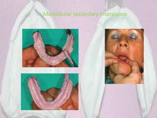 Mandibular secondary impression
 