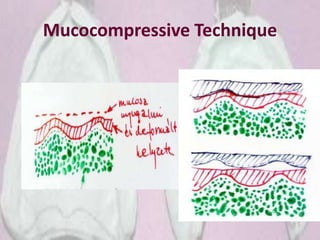 Mucocompressive Technique
 