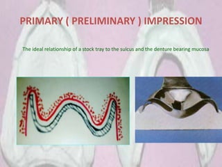 PRIMARY ( PRELIMINARY ) IMPRESSION
The ideal relationship of a stock tray to the sulcus and the denture bearing mucosa
 