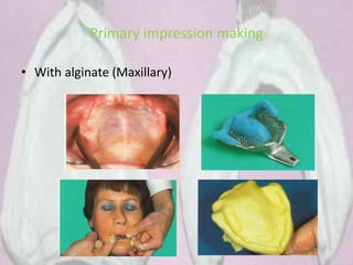 Primary impression making
• With alginate (Maxillary)
 