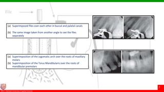 © Ramaiah University of Applied Sciences
7
Faculty of Dental Sciences©M. S. Ramaiah University of Applied Sciences
7
(a) Superimposed files over each other in buccal and palatal canals
(b) The same image taken from another angle to see the files
separately
(a) Superimposition of the zygomatic arch over the roots of maxillary
molars
(b) Superimposition of the Torus Mandibularis over the roots of
mandibular premolars
 