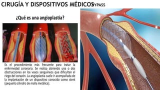 CIRUGÍA Y DISPOSITIVOS MÉDICOS
BYPASS
 