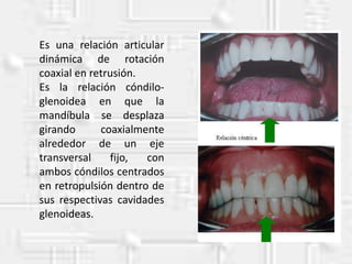 Es una relación articular
dinámica de rotación
coaxial en retrusión.
Es la relación cóndilo-
glenoidea en que la
mandíbula se desplaza
girando coaxialmente
alrededor de un eje
transversal fijo, con
ambos cóndilos centrados
en retropulsión dentro de
sus respectivas cavidades
glenoideas.
 