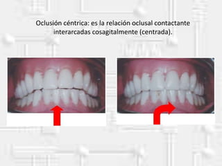 Oclusión céntrica: es la relación oclusal contactante
interarcadas cosagitalmente (centrada).
 