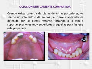 OCLUSION MUTUAMENTE COMPARTIDA.
Cuando existe carencia de piezas dentarias posteriores, ya
sea de un solo lado o de ambos , el cierre mandibular es
detenido por las piezas restante, forzando a la atm a
soportar presiones muy superiores a aquellas para las que
esta preparada.
 