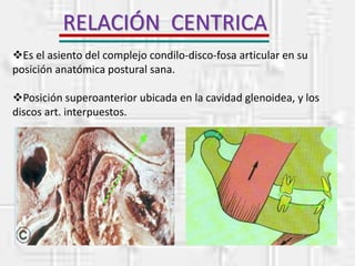 RELACIÓN CENTRICA
Es el asiento del complejo condilo-disco-fosa articular en su
posición anatómica postural sana.
Posición superoanterior ubicada en la cavidad glenoidea, y los
discos art. interpuestos.
 