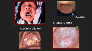 ALGORRA DEL RN
C. ORAL Y SIDA
Queilitis
 