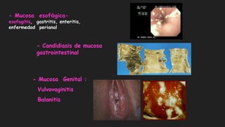 - Candidiasis de mucosa
gastrointestinal
- Mucosa esofágica-
esofagitis, gastritis, enteritis,
enfermedad perianal
- Mucosa Genital :
Vulvovaginitis
Balanitis
 