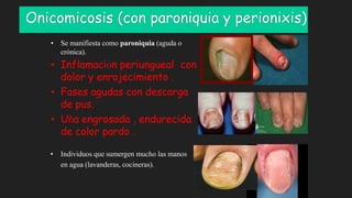 Onicomicosis (con paroniquia y perionixis)
• Se manifiesta como paroniquia (aguda o
crónica).
• Inflamación periungueal con
dolor y enrojecimiento .
• Fases agudas con descarga
de pus.
• Uña engrosada , endurecida
de color pardo .
• Individuos que sumergen mucho las manos
en agua (lavanderas, cocineras).
 