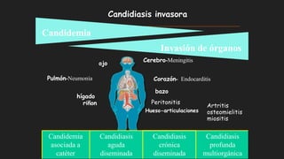 Candidiasis invasora
ojo
Pulmón-Neumonía
hígado
riñon
Candidemia
Invasión de órganos
Cerebro-Meningitis
Candidemia
asociada a
catéter
Candidiasis
aguda
diseminada
Candidiasis
crónica
diseminada
Candidiasis
profunda
multiorgánica
Artritis
osteomielitis
miositis
Hueso-articulaciones
Corazón- Endocarditis
bazo
Peritonitis
 