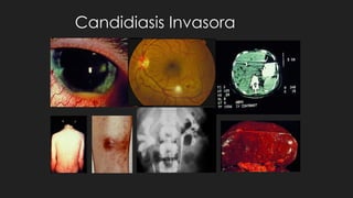 Candidiasis Invasora
 
