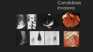 Candidiasis
invasora
 