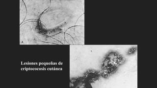 Lesiones pequeñas de
criptococosis cutánea
 