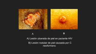 A) Lesión ulcerada de piel en paciente HIV
B) Lesión nodular de piel causada por C.
neoformans.
A B
 