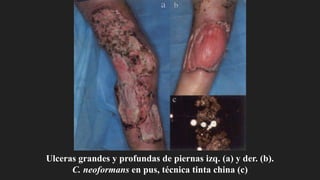 Ulceras grandes y profundas de piernas izq. (a) y der. (b).
C. neoformans en pus, técnica tinta china (c)
 