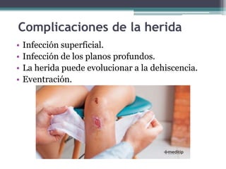 Complicaciones de la herida
• Infección superficial.
• Infección de los planos profundos.
• La herida puede evolucionar a ...
