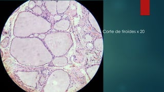 Corte de tiroides x 20
 