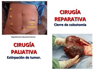 CIRUGÍA
REPARATIVA

Cierre de colostomia

CIRUGÍA
PALIATIVA

Extirpación de tumor.

 
