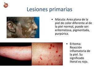 Lesiones primarias
• Mácula: Area plana de la
piel de color diferente al de
la piel normal, puede ser:
eritematosa, pigmentada,
purpúrica.
• Eritema:
Reacción
inflamatoria de
la piel. Su
significado
literal es rojo.
 